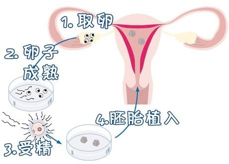 私人志愿者供卵助孕包生儿子试管婴儿中心